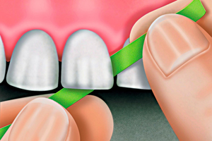 Abrasive polishing strips (Polydentia)