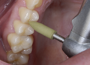 CompoMaster CA (Shofu)