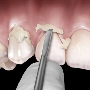 Cement Remover Novatech 12 (Hu-Friedy)