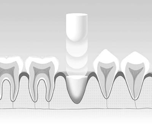 Foundation Bone Filler (J Morita)