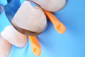 Unica Anterior Sectional Matrix System