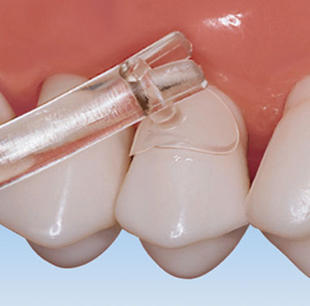 Cure-Thru Clear Cervical Matrices Cure-Thru Clear Cervical Matrices