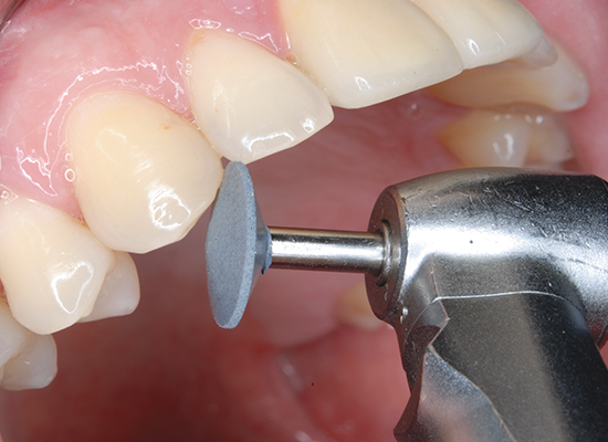 Ceramaster CA (Shofu) Ceramaster CA (Shofu)