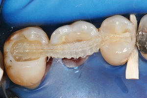 Fiber-Splint ML Multi-Layer (Polydentia)