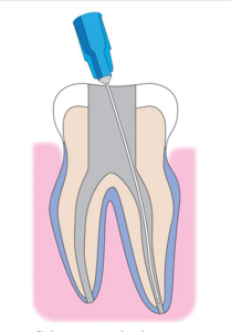 OptiProbe Needle Tips Side Port & Round Ended (Pacdent)