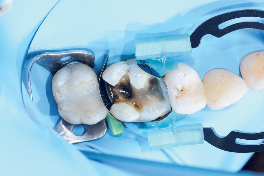 myTines (Polydentia)