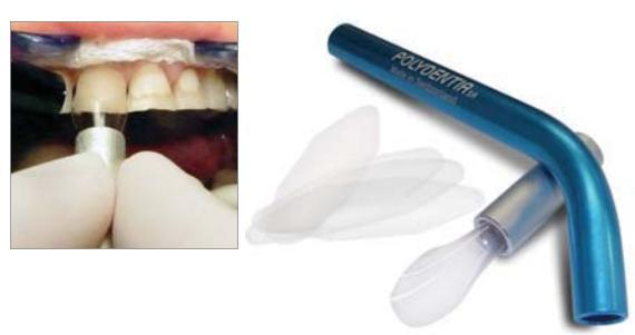 Cervical Former (Polydentia) Cervical Former (Polydentia)